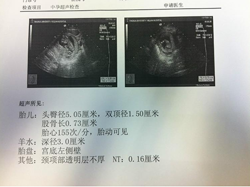 卵巢囊肿致不孕，供卵试管重获新生