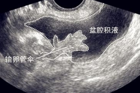 盆腔粘连导致不孕，如何科学应对？医学专家为你支招